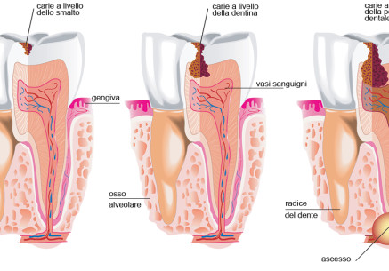 EVOLUZIONE CARIE - CLINIC TORINO